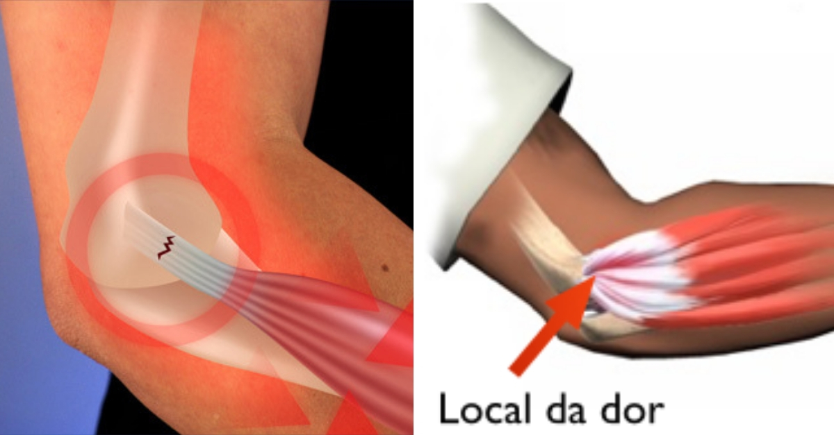 Epicondilitis Lateral Conoce Todo Sobre El Codo Del Tenista