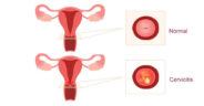 Cervicitis qué es causas síntomas y tratamiento