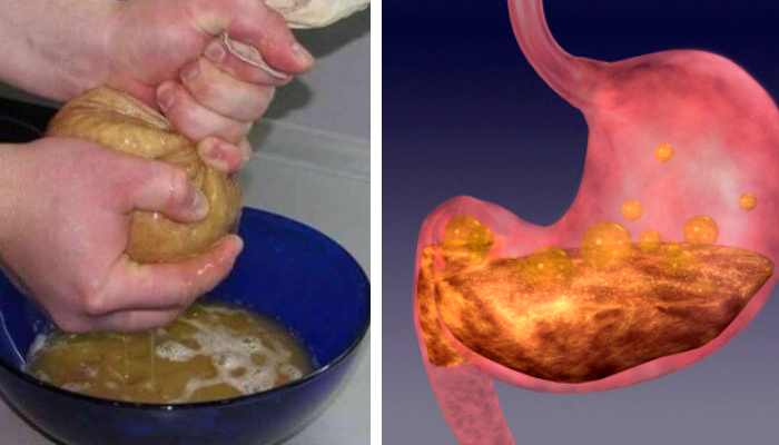 Gastritis Recetas Caseras Que Acabar N Con La Acidez Gastritis Y Reflujo