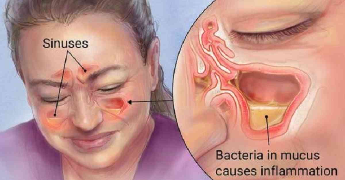 Difference Between Rhinitis And Sinusitis Compare The