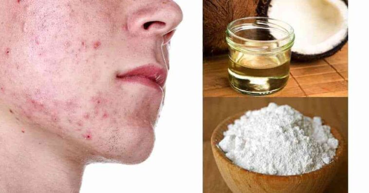 Crema hidratante para eliminar el acné