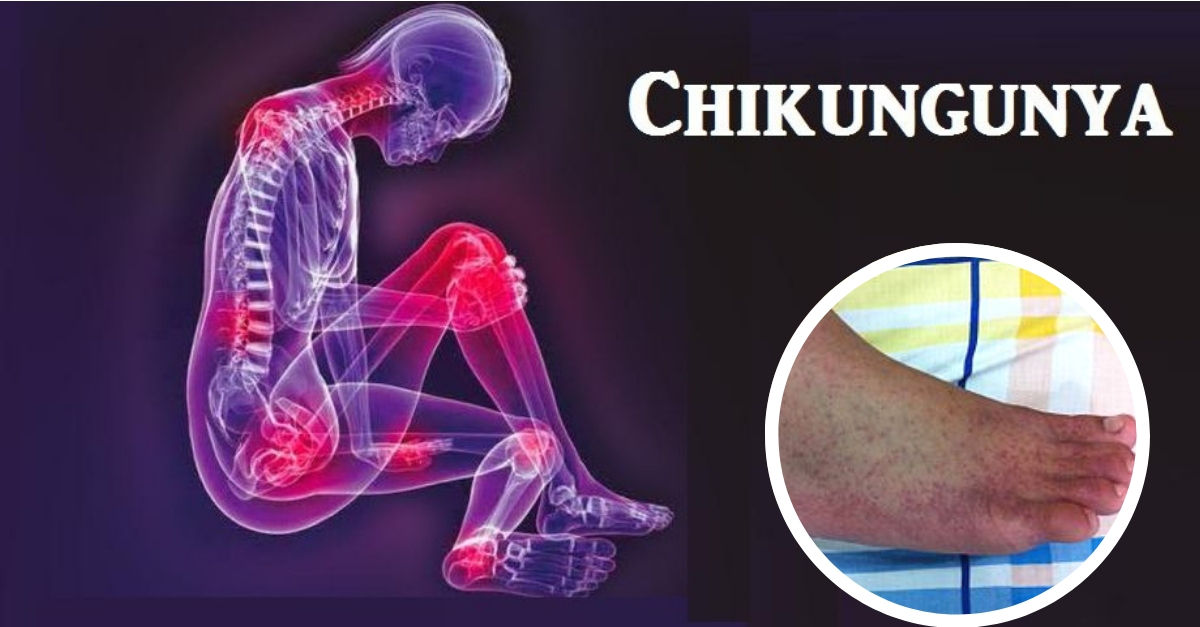Chikungunya síntomas, transmisión y tratamiento