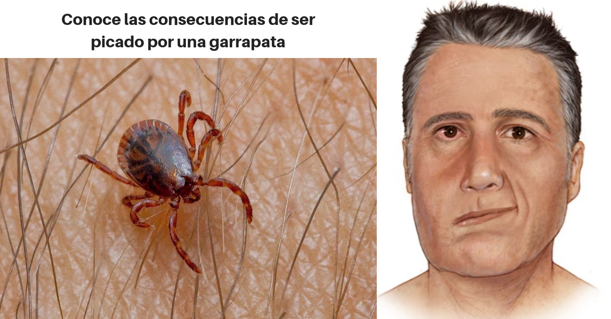 Enfermedad De Lyme Síntomas Y Tratamientos