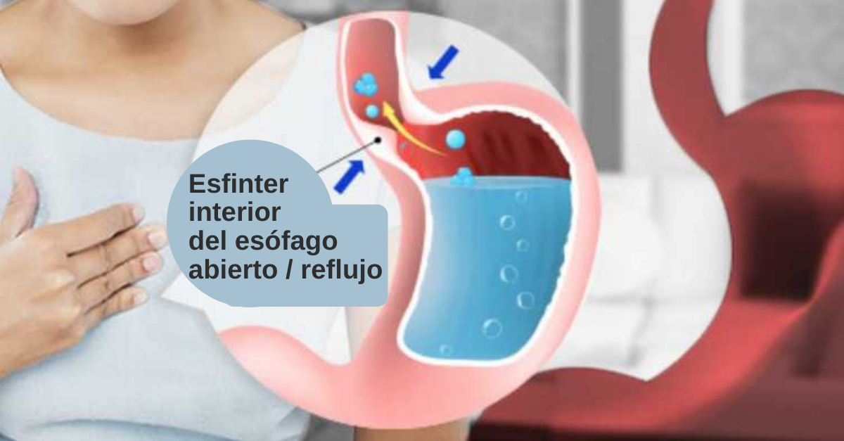 ¿Qué Comer En La Dieta Para El Reflujo? Conoce Qué Cuidados Debes Tener ...