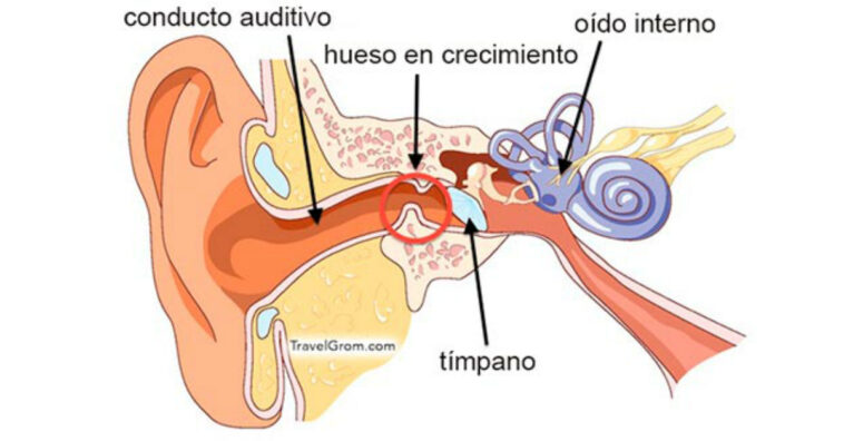 Exóstosis auditiva