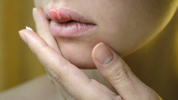 herpes labial está relacionado con la disminución de la inmunidad