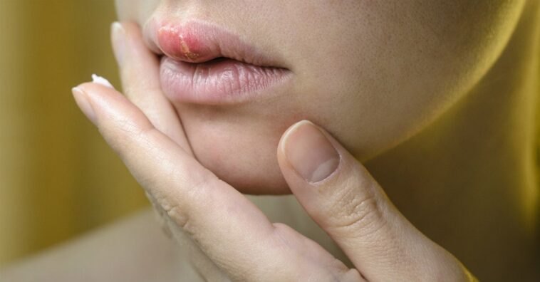 herpes labial está relacionado con la disminución de la inmunidad
