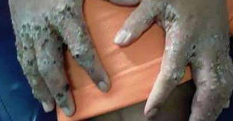 Presos con enfermedades infecciosas que corroen la piel son hospitalizados en Roraima