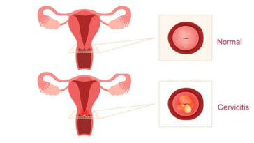 cervicitis