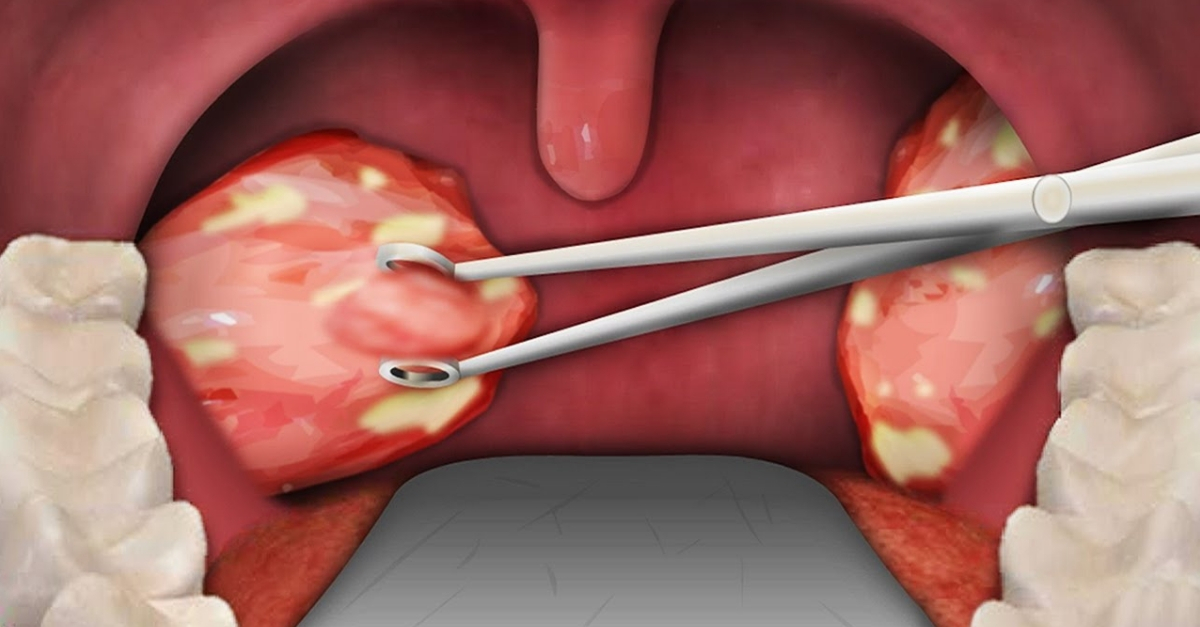 Retirar Las Amígdalas Aumenta El Riesgo De Enfermedades Respiratorias