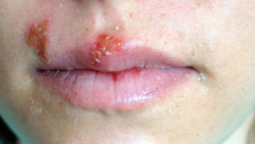 curar el herpes labial