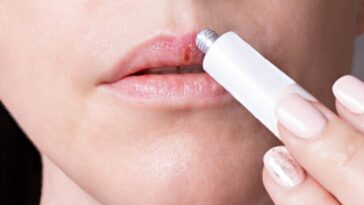 Cómo tratar el herpes labial