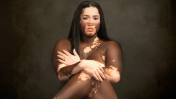 modelo con vitiligo revela el abuso racista