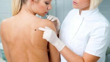 identificar un melanoma