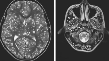 neurocisticercosis