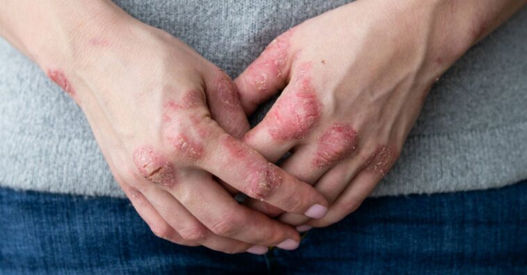 nuevo tratamiento para la psoriasis