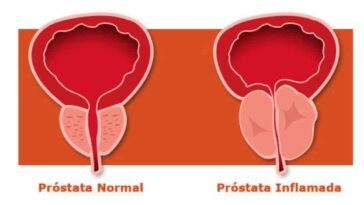dolores en la próstata