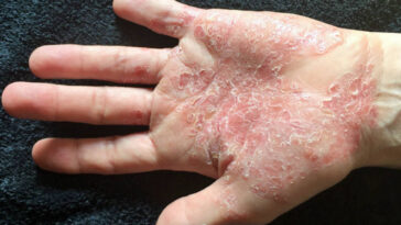 Psoriasis