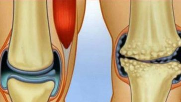 cartílago, ligamentos y rodillas