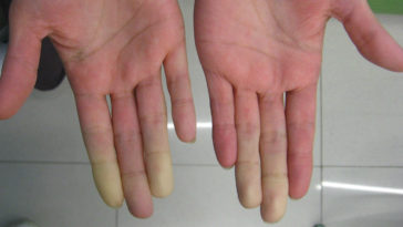 síndrome de Raynaud