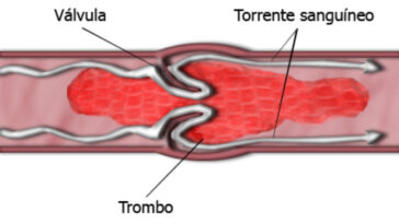 síntomas de una trombosis